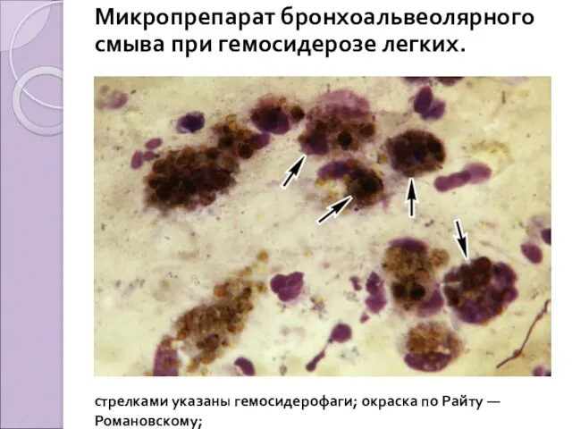 Микропрепарат бронхоальвеолярного смыва при гемосидерозе легких. стрелками указаны гемосидерофаги; окраска по Райту — Романовскому;