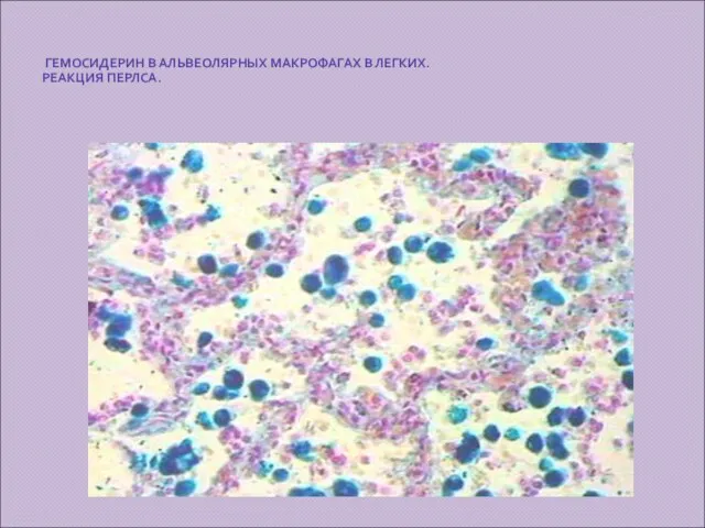 ГЕМОСИДЕРИН В АЛЬВЕОЛЯРНЫХ МАКРОФАГАХ В ЛЕГКИХ. РЕАКЦИЯ ПЕРЛСА.