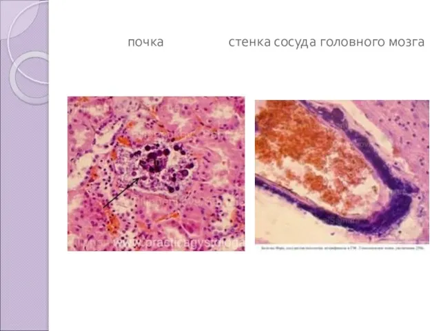 почка стенка сосуда головного мозга