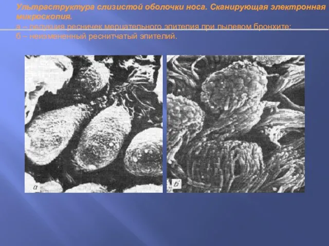 Ультраструктура слизистой оболочки носа. Сканирующая электронная микроскопия. а – редукция