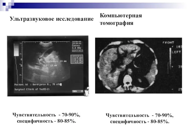 Ультразвуковое исследование Чувствительность - 70-90%, специфичность - 80-85%. Компьютерная томография Чувствительность - 70-90%, специфичность - 80-85%.