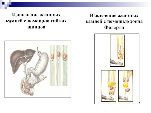 Извлечение желчных камней с помощью гибких щипцов Извлечение желчных камней с помощью зонда Фогарти