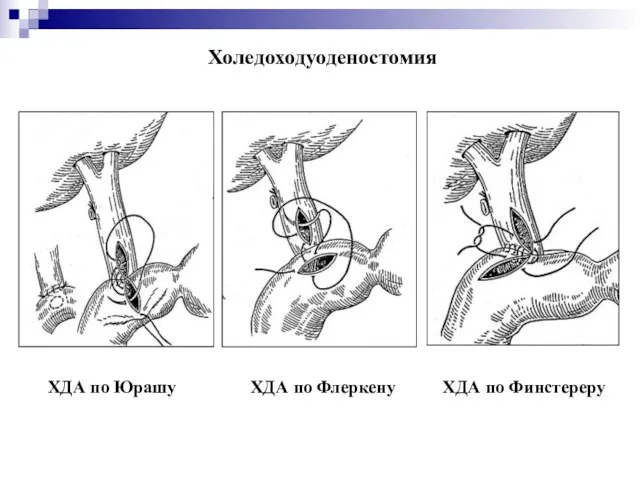 Холедоходуоденостомия ХДА по Юрашу ХДА по Флеркену ХДА по Финстереру