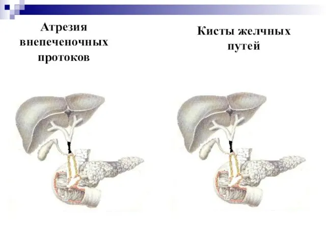 Атрезия внепеченочных протоков Кисты желчных путей