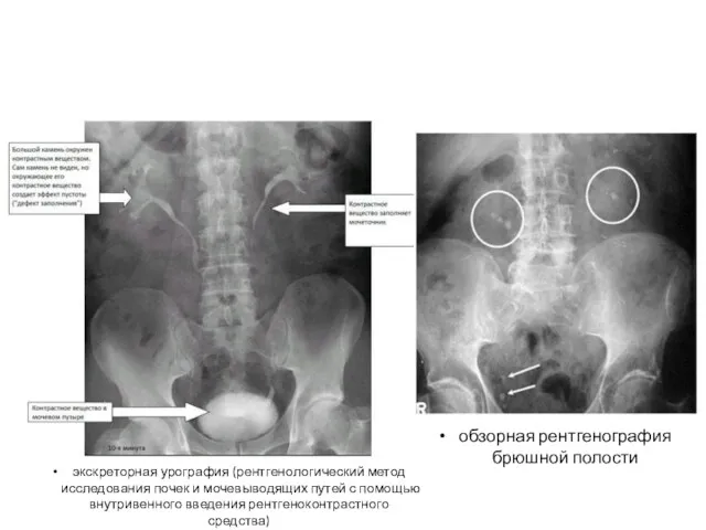 обзорная рентгенография брюшной полости экскреторная урография (рентгенологический метод исследования почек и мочевыводящих путей