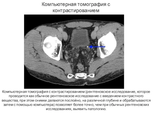 КТ Компьютерная томография с контрастированием (рентгеновское исследование, которое проводится как обычное рентгеновское исследование