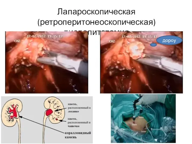 Лапароскопическая (ретроперитонеоскопическая) пиелолитотомия дороу