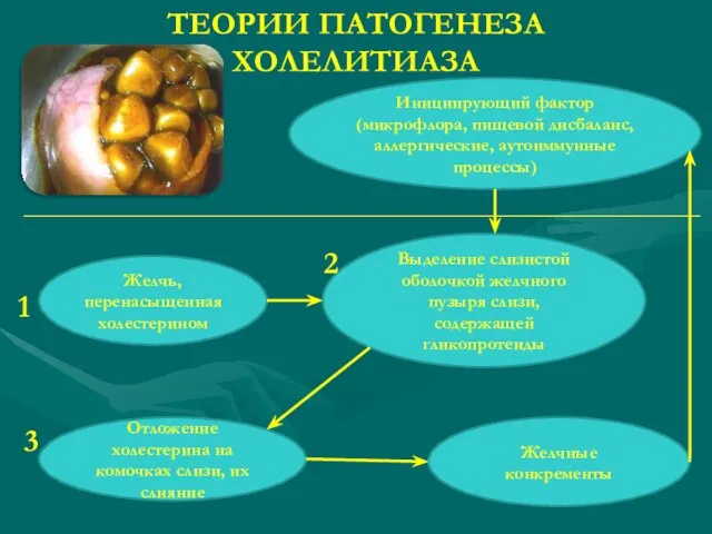 ТЕОРИИ ПАТОГЕНЕЗА ХОЛЕЛИТИАЗА Желчь, перенасыщенная холестерином Выделение слизистой оболочкой желчного