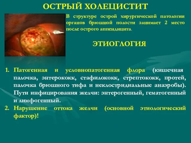 ОСТРЫЙ ХОЛЕЦИСТИТ В структуре острой хирургической патологии органов брюшной полости