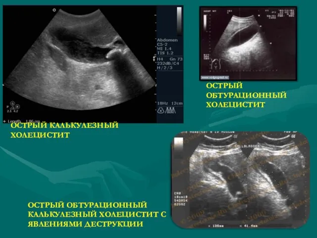 ОСТРЫЙ КАЛЬКУЛЕЗНЫЙ ХОЛЕЦИСТИТ ОСТРЫЙ ОБТУРАЦИОННЫЙ КАЛЬКУЛЕЗНЫЙ ХОЛЕЦИСТИТ С ЯВЛЕНИЯМИ ДЕСТРУКЦИИ ОСТРЫЙ ОБТУРАЦИОННЫЙ ХОЛЕЦИСТИТ