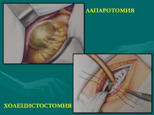 ЛАПАРОТОМИЯ ХОЛЕЦИСТОСТОМИЯ