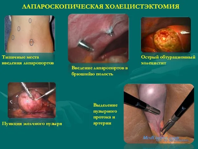 ЛАПАРОСКОПИЧЕСКАЯ ХОЛЕЦИСТЭКТОМИЯ Типичные места введения лапаропортов Введение лапаропортов в брюшнйю