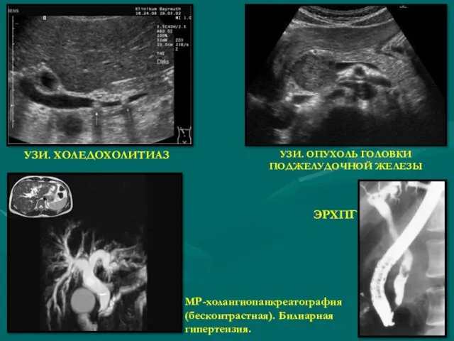 УЗИ. ХОЛЕДОХОЛИТИАЗ УЗИ. ОПУХОЛЬ ГОЛОВКИ ПОДЖЕЛУДОЧНОЙ ЖЕЛЕЗЫ МР-холангиопанкреатография (бесконтрастная). Билиарная гипертензия. ЭРХПГ