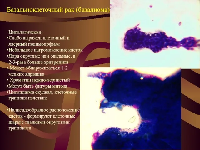 Базальноклеточный рак (базалиома) Цитологически: Слабо выражен клеточный и ядерный полимолрфизм
