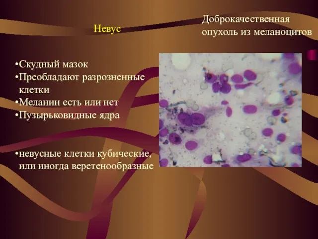 Невус Доброкачественная опухоль из меланоцитов Скудный мазок Преобладают разрозненные клетки