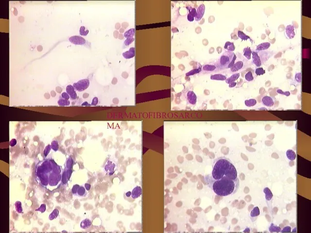 DERMATOFIBROSARCOMA