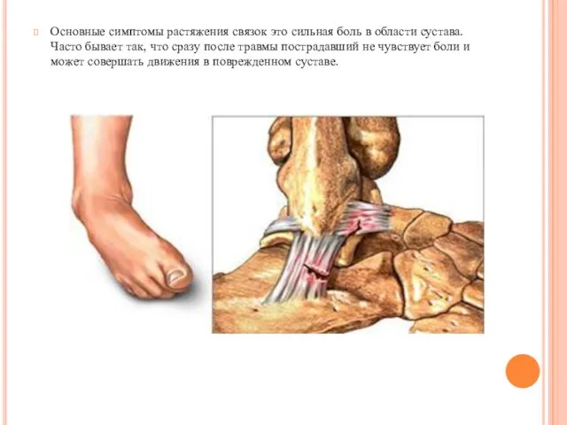 Основные симптомы растяжения связок это сильная боль в области сустава.