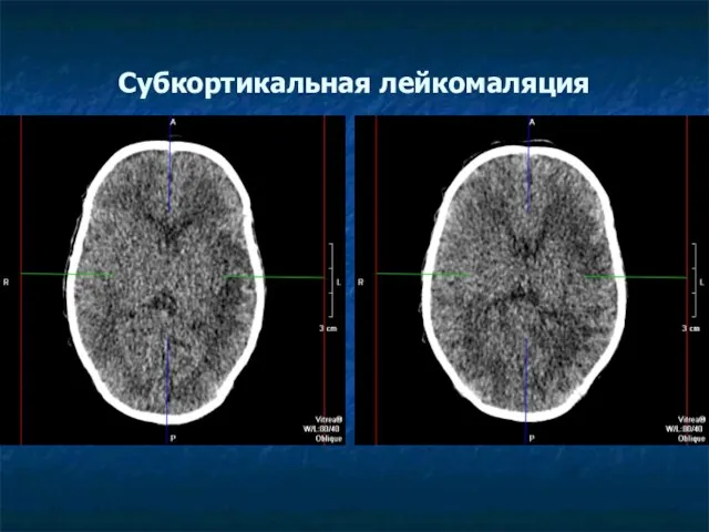 Субкортикальная лейкомаляция