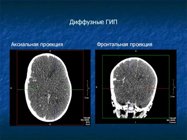 Диффузные ГИП Аксиальная проекция Фронтальная проекция