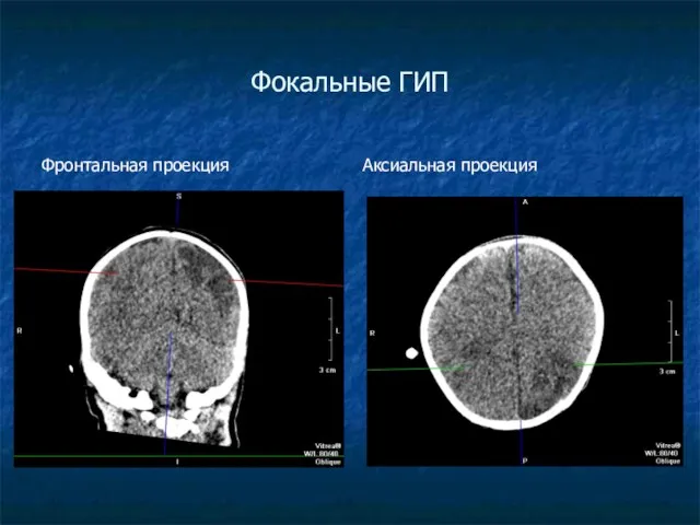 Фокальные ГИП Фронтальная проекция Аксиальная проекция