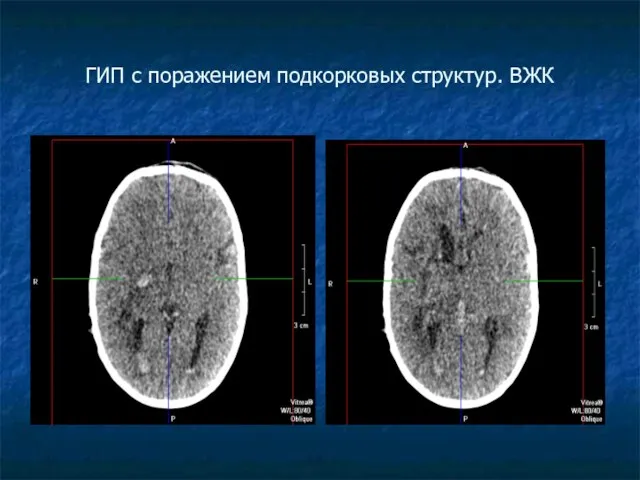 ГИП с поражением подкорковых структур. ВЖК