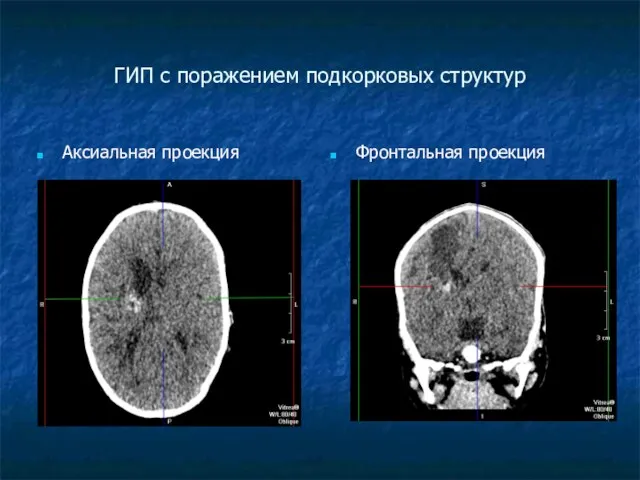 ГИП с поражением подкорковых структур Аксиальная проекция Фронтальная проекция