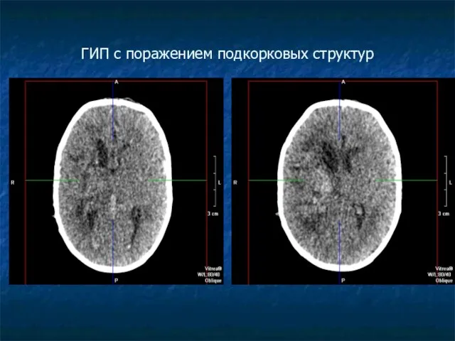 ГИП с поражением подкорковых структур