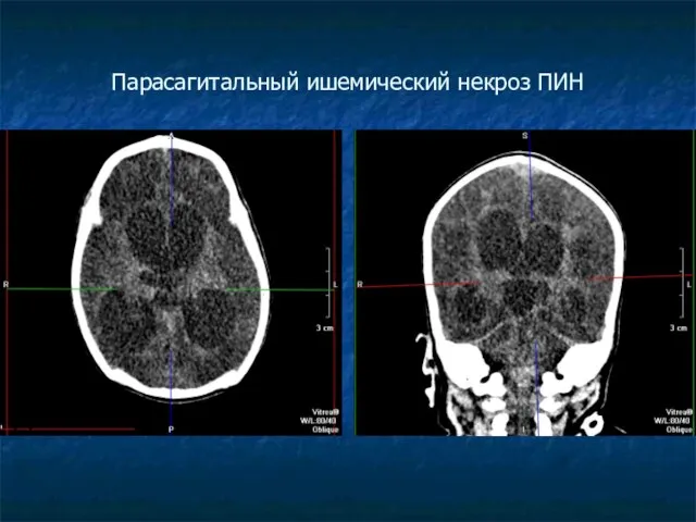 Парасагитальный ишемический некроз ПИН