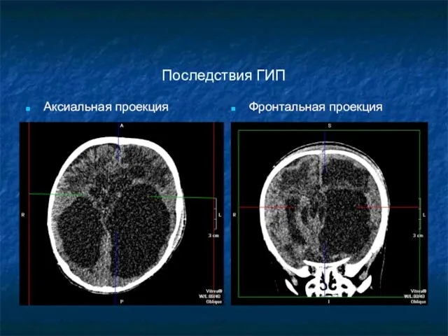 Последствия ГИП Аксиальная проекция Фронтальная проекция