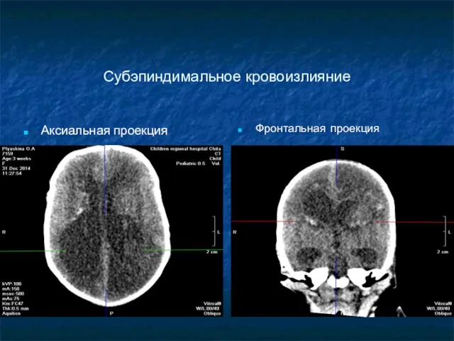 Субэпиндимальное кровоизлияние Аксиальная проекция Фронтальная проекция