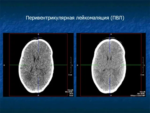 Перивентрикулярная лейкомаляция (ПВЛ)