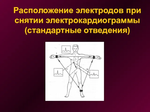 Расположение электродов при снятии электрокардиограммы (стандартные отведения)