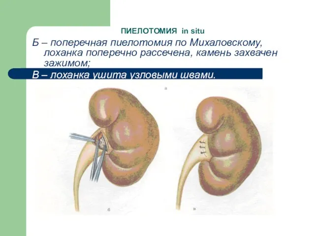 ПИЕЛОТОМИЯ in situ Б – поперечная пиелотомия по Михаловскому, лоханка поперечно рассечена, камень