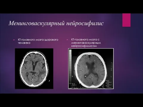 Менинговаскулярный нейросифилис КТ-головного мозга здорового человека КТ-головного мозга с менинговаскулярным нейросифилисом