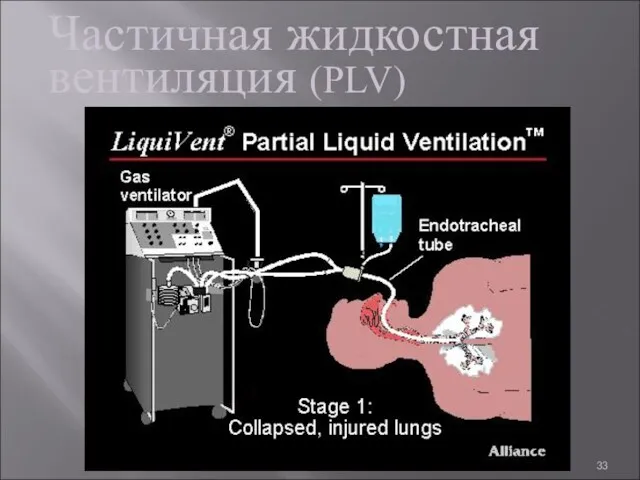 Частичная жидкостная вентиляция (PLV)