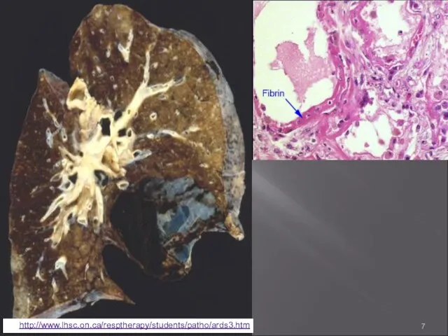 По: http://www.lhsc.on.ca/resptherapy/students/patho/ards3.htm