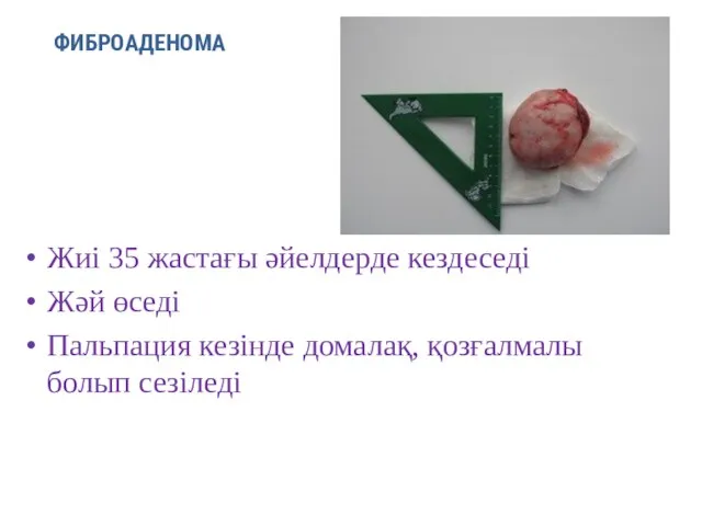 ФИБРОАДЕНОМА Жиі 35 жастағы әйелдерде кездеседі Жәй өседі Пальпация кезінде домалақ, қозғалмалы болып сезіледі