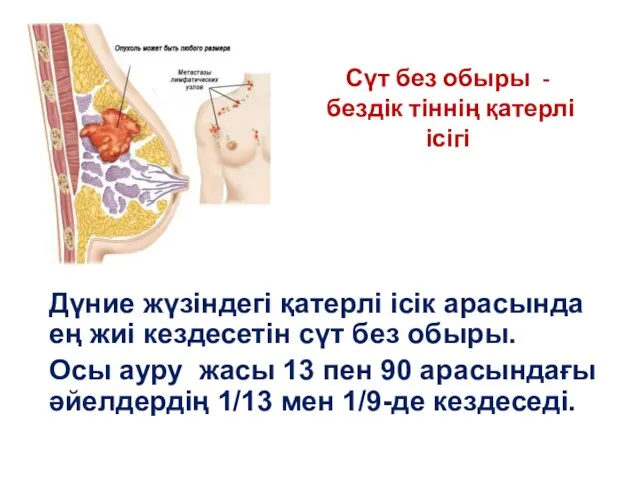 Дүние жүзіндегі қатерлі ісік арасында ең жиі кездесетін сүт без