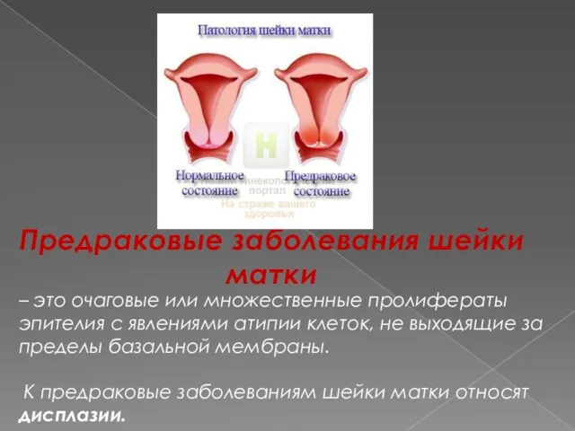 Предраковые заболевания шейки матки – это очаговые или множественные пролифераты