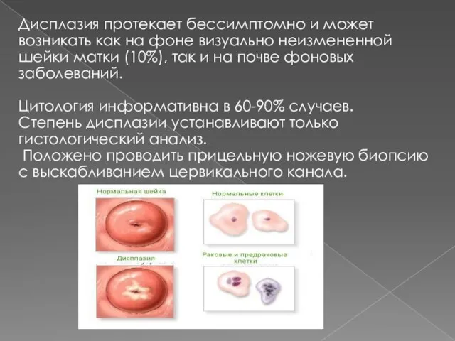 Дисплазия протекает бессимптомно и может возникать как на фоне визуально