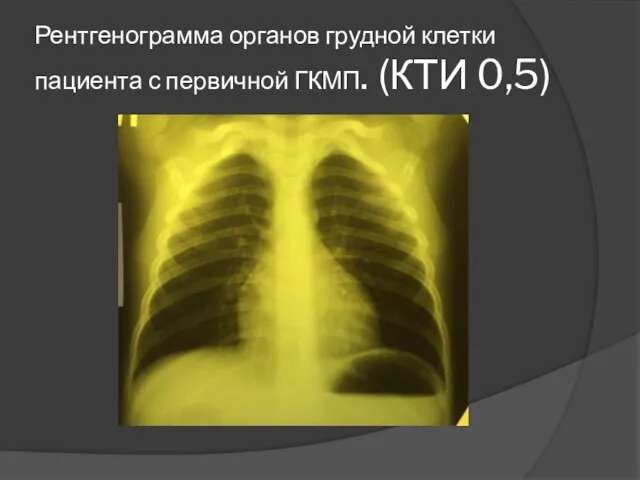 Рентгенограмма органов грудной клетки пациента с первичной ГКМП. (КТИ 0,5)