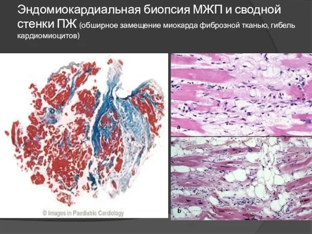 Эндомиокардиальная биопсия МЖП и сводной стенки ПЖ (обширное замещение миокарда фиброзной тканью, гибель кардиомиоцитов)