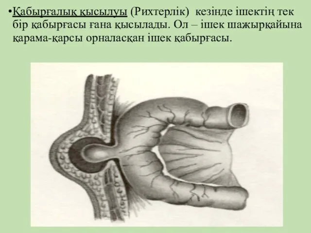 Қабырғалық қысылуы (Рихтерлiк) кезiнде iшектiң тек бiр қабырғасы ғана қысылады.