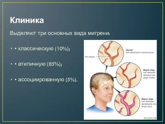 Клиника Выделяют три основных вида мигрени: • классическую (10%); • атипичную (85%); • ассоциированную (5%).