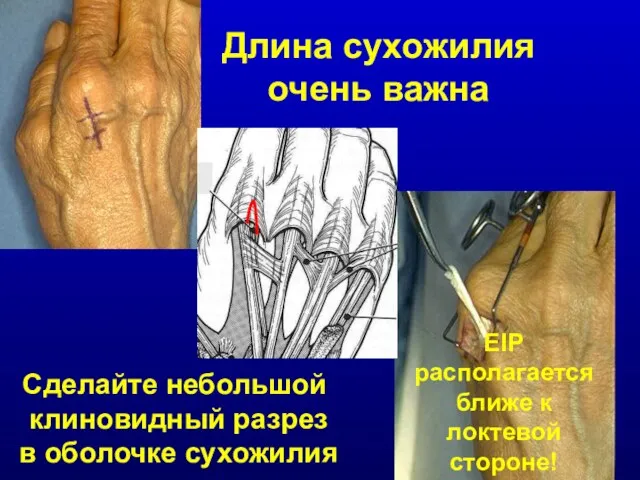 Длина сухожилия очень важна EIP располагается ближе к локтевой стороне!