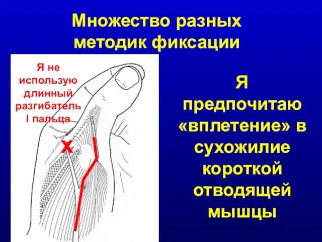 Множество разных методик фиксации Я предпочитаю «вплетение» в сухожилие короткой отводящей мышцы