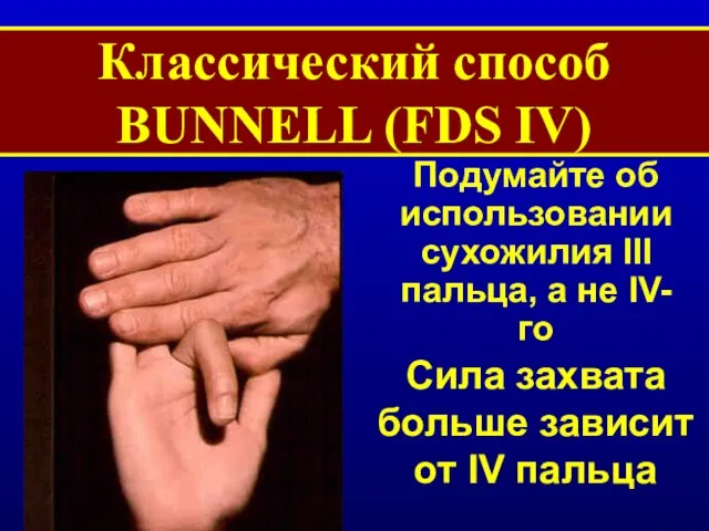 Классический способ BUNNELL (FDS IV) Подумайте об использовании сухожилия III