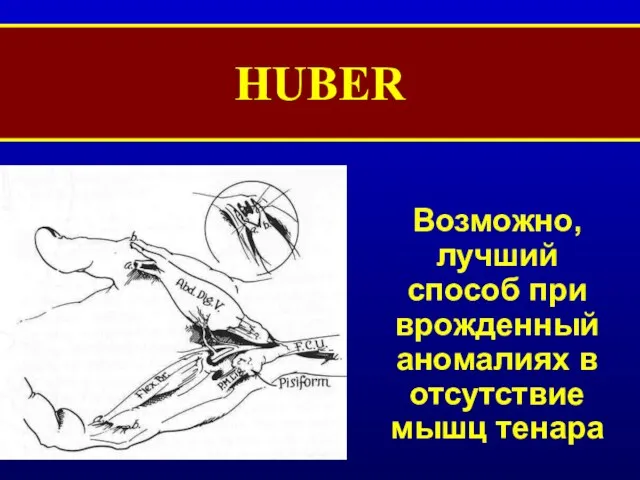 HUBER Возможно, лучший способ при врожденный аномалиях в отсутствие мышц тенара