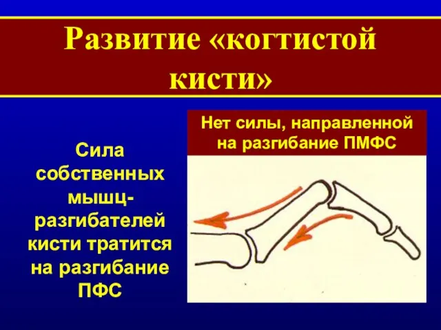 Развитие «когтистой кисти» Сила собственных мышц-разгибателей кисти тратится на разгибание ПФС