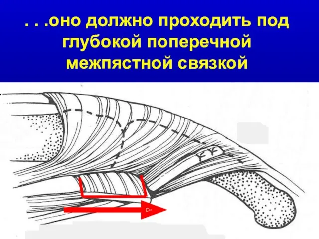 . . .оно должно проходить под глубокой поперечной межпястной связкой